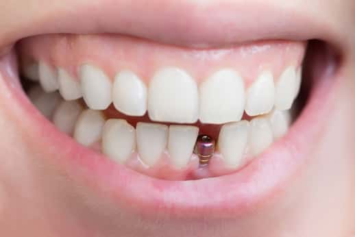 مراقبت های لازم بعد از ایمپلنت دندان