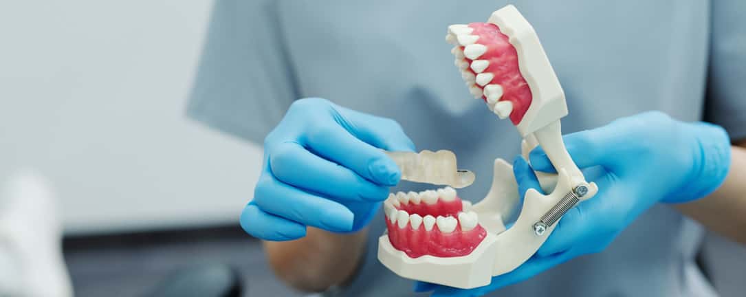 عوامل موثر در هزینه یمپلنت دندان