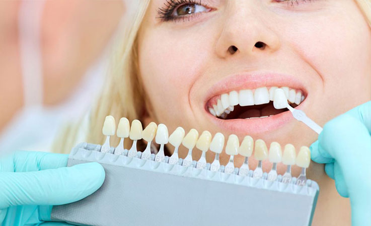 مزایا و معایب لمینیت دندان