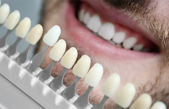 مقایسه لمینیت دندان با روش‌های دیگر
